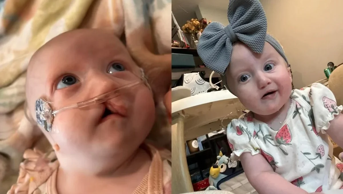 Recém-nascida é diagnosticada com microglossia, condição com menos de 50 casos no mundo