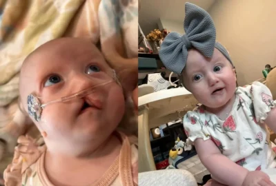 Recém-nascida é diagnosticada com microglossia, condição com menos de 50 casos no mundo