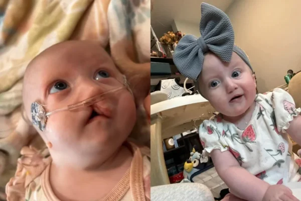 Recém-nascida é diagnosticada com microglossia, condição com menos de 50 casos no mundo